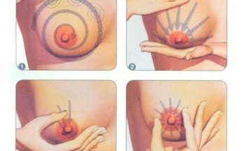 cương sữa và tắc tia sữa